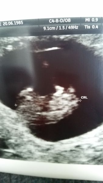 RESPONSE Trial for Recurrent Miscarriage - Thread 4