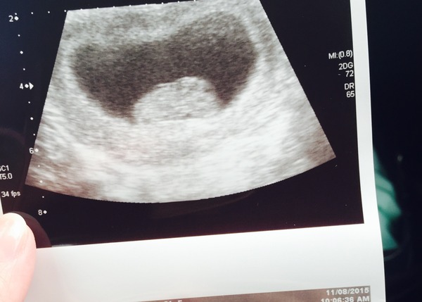 March 2016 Babies!! Our Grape-sized babies are getting Bigger!