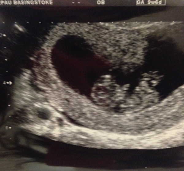 March 2016 Babies!! Our Grape-sized babies are getting Bigger!