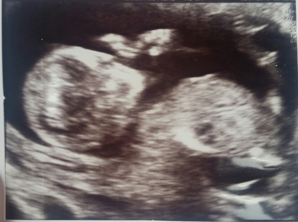 Jan 2016 #8 Enjoying second trimester and 20 week scans