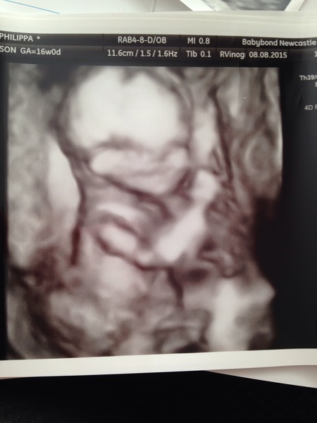 RESPONSE Trial for Recurrent Miscarriage - Thread 4