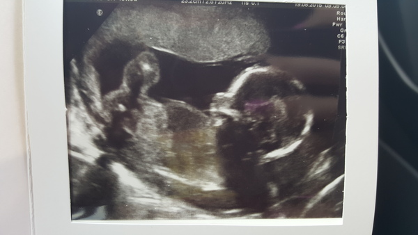 Jan 2016 #8 Enjoying second trimester and 20 week scans