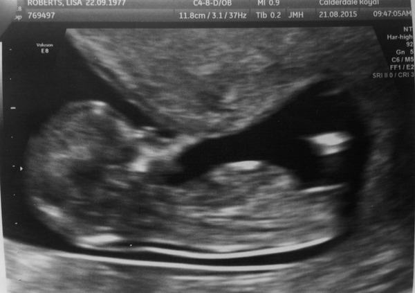 Second or subsequent babies due Jan/Feb/March 2016