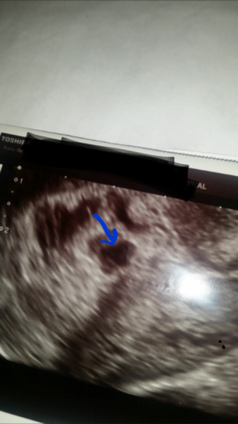 March 2016 Babies!! Our Grape-sized babies are getting Bigger!