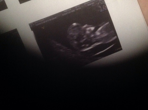 High nuchal fluid