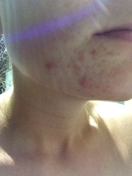 Help! Spotty chin