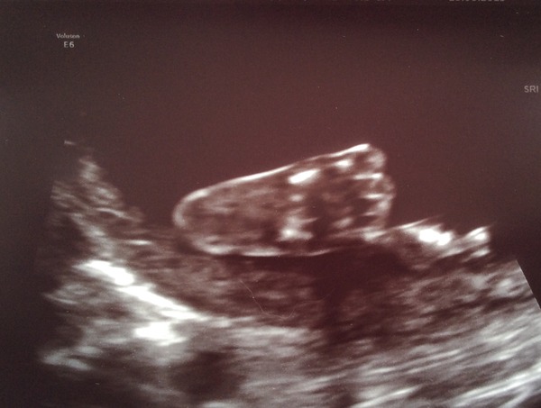 Jan 16 #9 halfway point - time to watch our bumps grow î