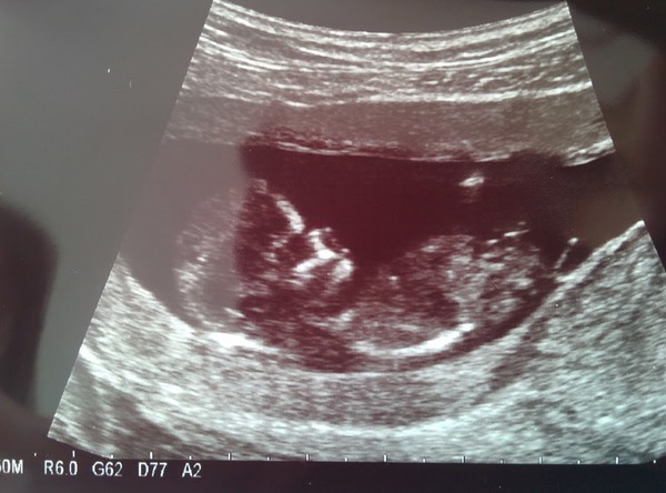 March 2016 Babies!! Our Grape-sized babies are getting Bigger!