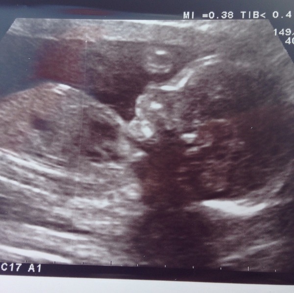 Jan 2016 #8 Enjoying second trimester and 20 week scans