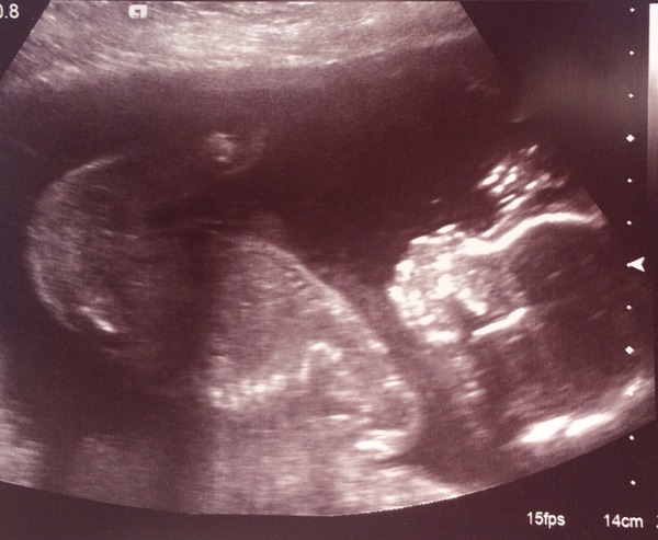 Boy or girl?