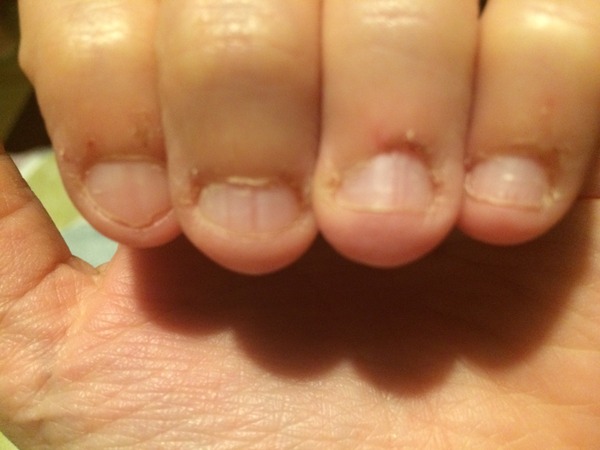 Disgusting nails (pics)