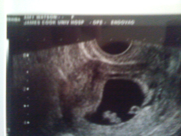 What name did you give your baby when you found out you were pregnant? E.g. Peanut