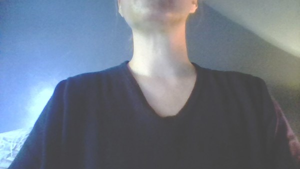 Just had a PDO threadlift