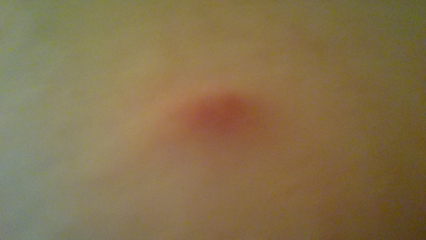 What is this lump on my stomach?