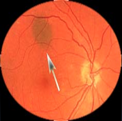 Does anybody have a freckle behind their eye?