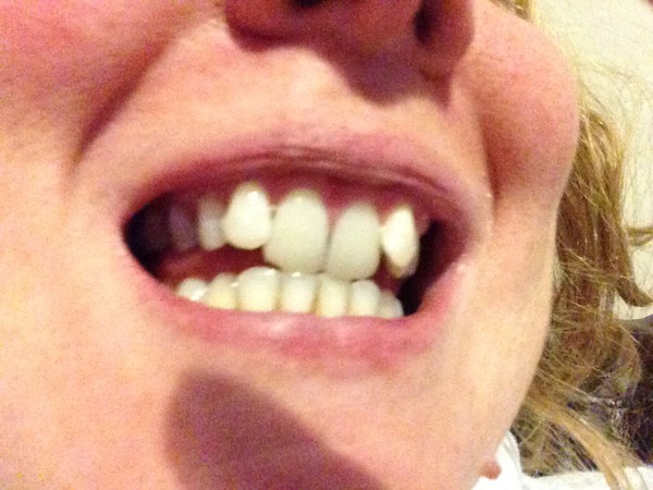 Late 30s - would you get orthodontics (photo)