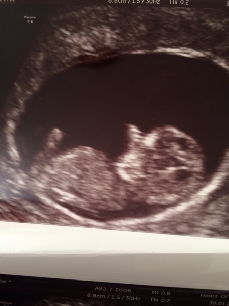 RESPONSE Trial for Recurrent Miscarriage - Thread 4