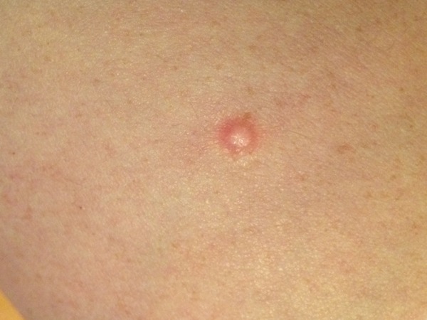 What is this nodule on my thigh?