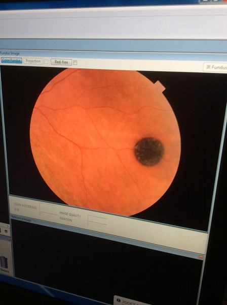 Does anybody have a freckle behind their eye?