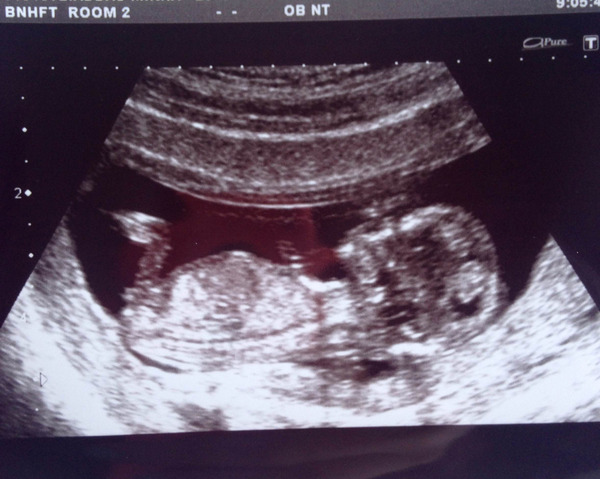 March 2016 Babies!! Our Grape-sized babies are getting Bigger!