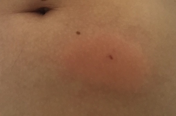 Freaking out about injections tomorrow. Thinking of backing out!!!