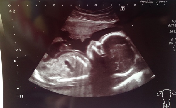 Jan 2016 #8 Enjoying second trimester and 20 week scans