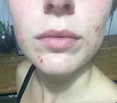 Would you say this is acne??