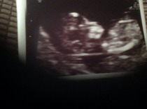 High nuchal fluid
