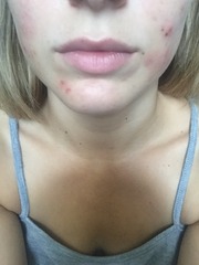 Would you say this is acne??