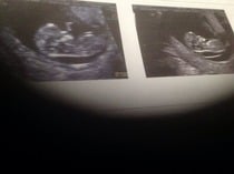 Where do I go now. 4.5mm nuchal fluid.