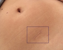 Laparoscopy - Scar treatment