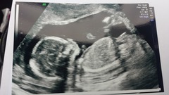 Jan 2016 #8 Enjoying second trimester and 20 week scans