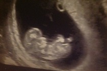 High nuchal fluid