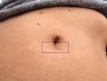 Laparoscopy - Scar treatment