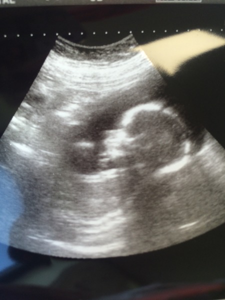 February 2016 - Boobs are growing, sickness is going, and some of us are finally showing!!