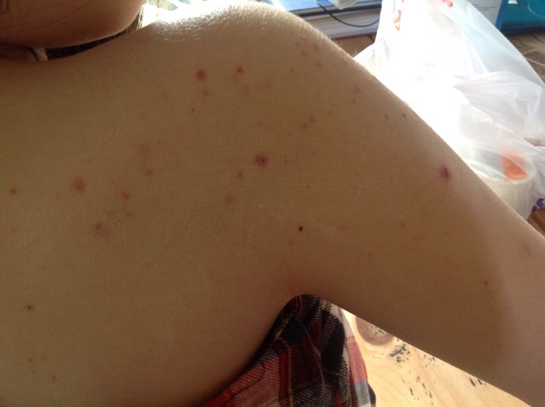 Does  this look like shingles?