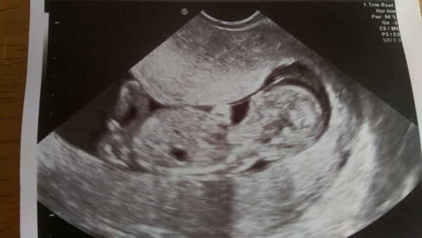 Whilst the rest of us chowed down on runny eggs and shellfish, deeply sneezed out a baby!...It's superb scans all around and only the occasional nose-vom on JS Grads 38!