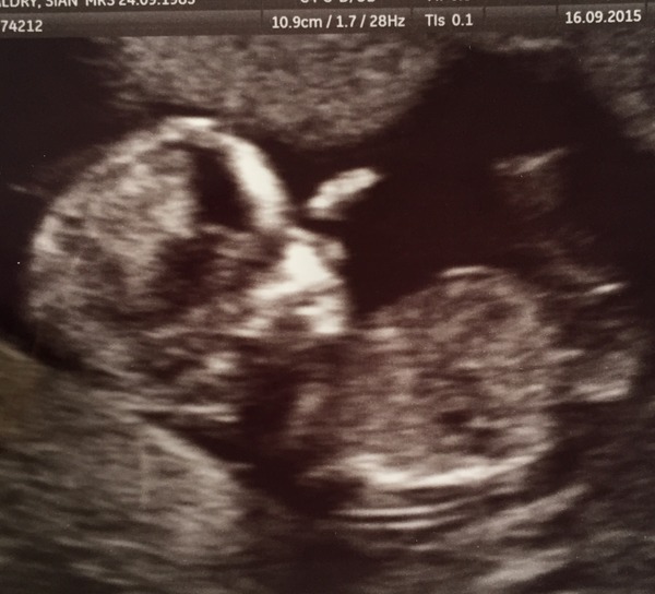 April 2016 babies. Nausea, bloating and wind - feeling HOT!