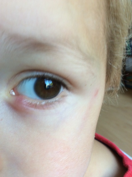 DS - eye problem. Doctors?