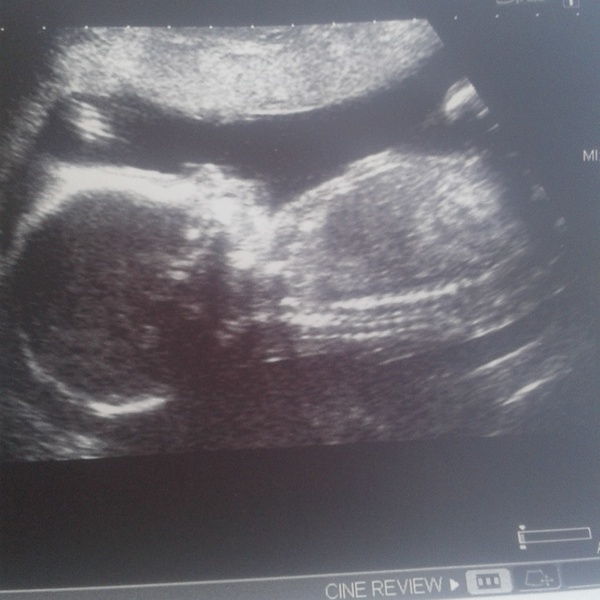 February 2016 - Boobs are growing, sickness is going, and some of us are finally showing!!