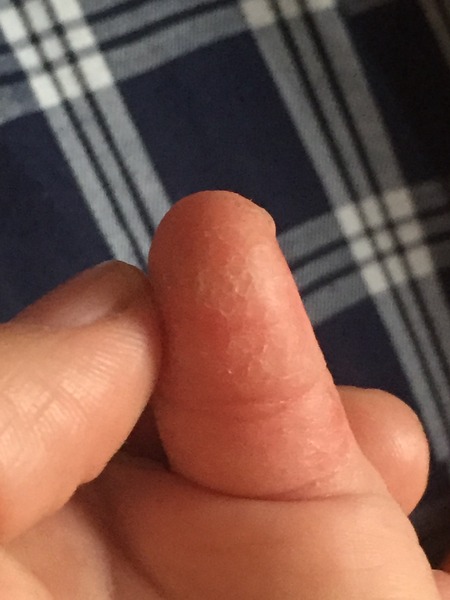 Skin on thumb from sucking.