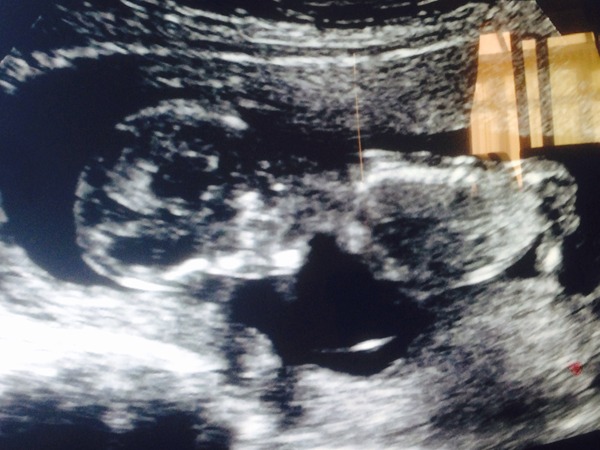 13 week gender predictions please!