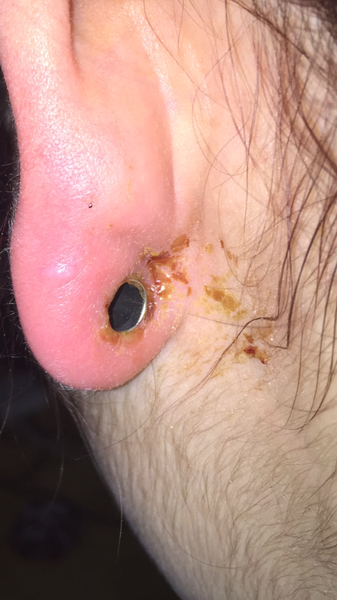 Should I see a GP or go to a MIU? (A little bit gross)