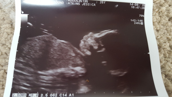 Whilst the rest of us chowed down on runny eggs and shellfish, deeply sneezed out a baby!...It's superb scans all around and only the occasional nose-vom on JS Grads 38!