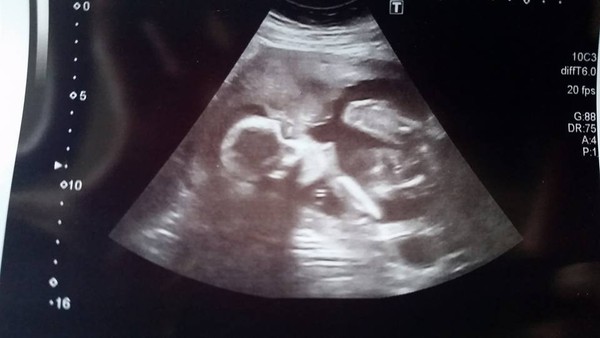 February 2016 - Boobs are growing, sickness is going, and some of us are finally showing!!