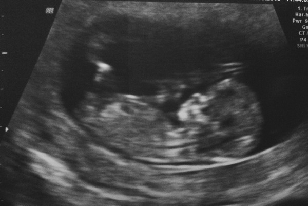 April 2016 babies. Nausea, bloating and wind - feeling HOT!