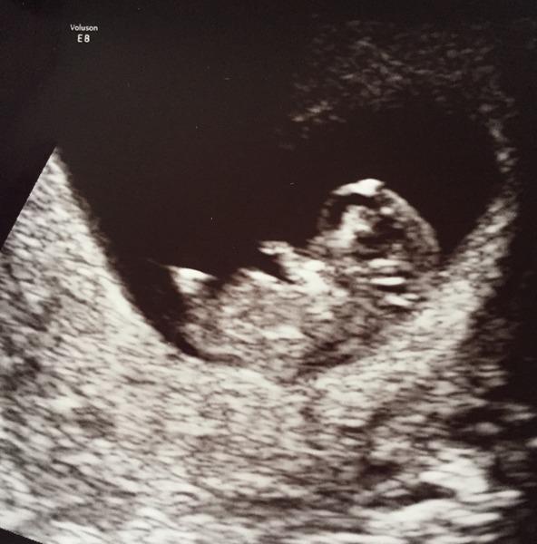 April 2016 babies. Nausea, bloating and wind - feeling HOT!