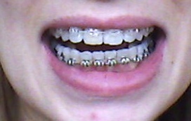 Adult braces - still not happy :(