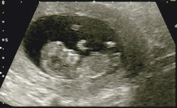 March 2016 #4 - entering the second trimester at last and (hopefully) waving goodbye to sickness