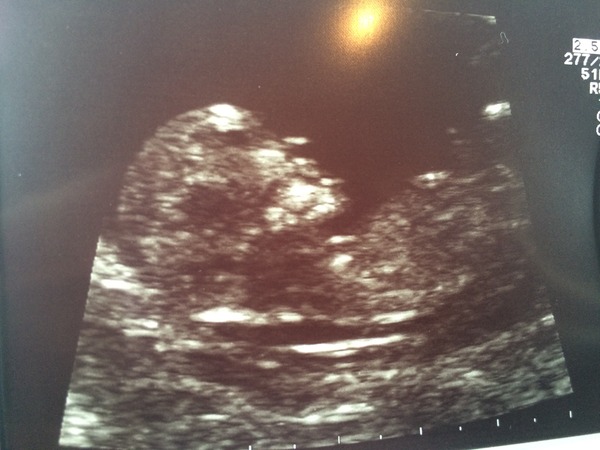 April 2016 babies. Nausea, bloating and wind - feeling HOT!